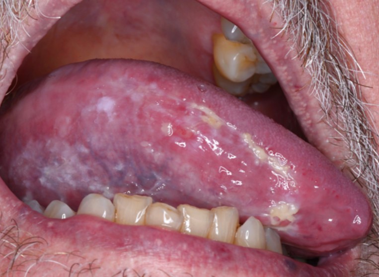 Mouth Cancer header image alternative image